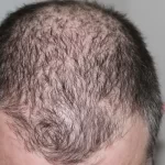 Diminishing Testosterone and Hair Loss